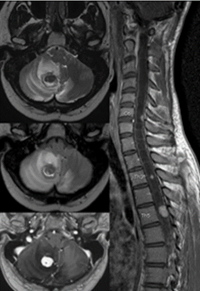 Neuro - Brain & Spine MRI 2026