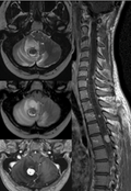 Neuro - Brain & Spine MRI 2026